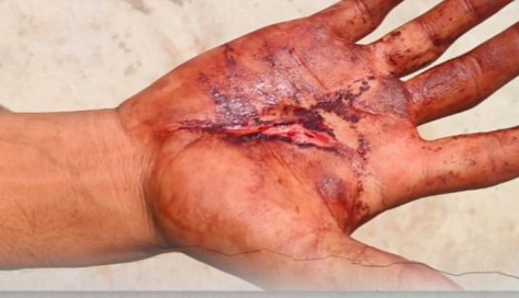 Jashpur Crime : पत्थलगांव क्षेत्र में अज्ञात हमलावरों ने चाकू और लोहे के कड़े से किया युवकों पर हमला..एक युवक की हथेली गंभीर रूप से घायल..अस्पताल में भर्ती..पुलिस जांच में जुटी..पढ़ें पूरी ख़बर