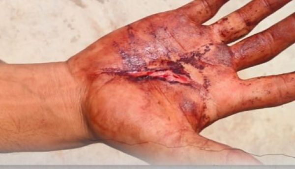 Jashpur Crime : पत्थलगांव क्षेत्र में अज्ञात हमलावरों ने चाकू और लोहे के कड़े से किया युवकों पर हमला..एक युवक की हथेली गंभीर रूप से घायल..अस्पताल में भर्ती..पुलिस जांच में जुटी..पढ़ें पूरी ख़बर