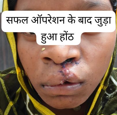 जन्मजात होंठ की गंभीर विकृति से मिली आज़ादी, बीजापुर जिला अस्पताल में सफल सर्जरी ने 22 वर्षीय भीमे हेमला की ज़िंदगी बदली, चेहरे पर लौटी मुस्कान और आत्मविश्वास